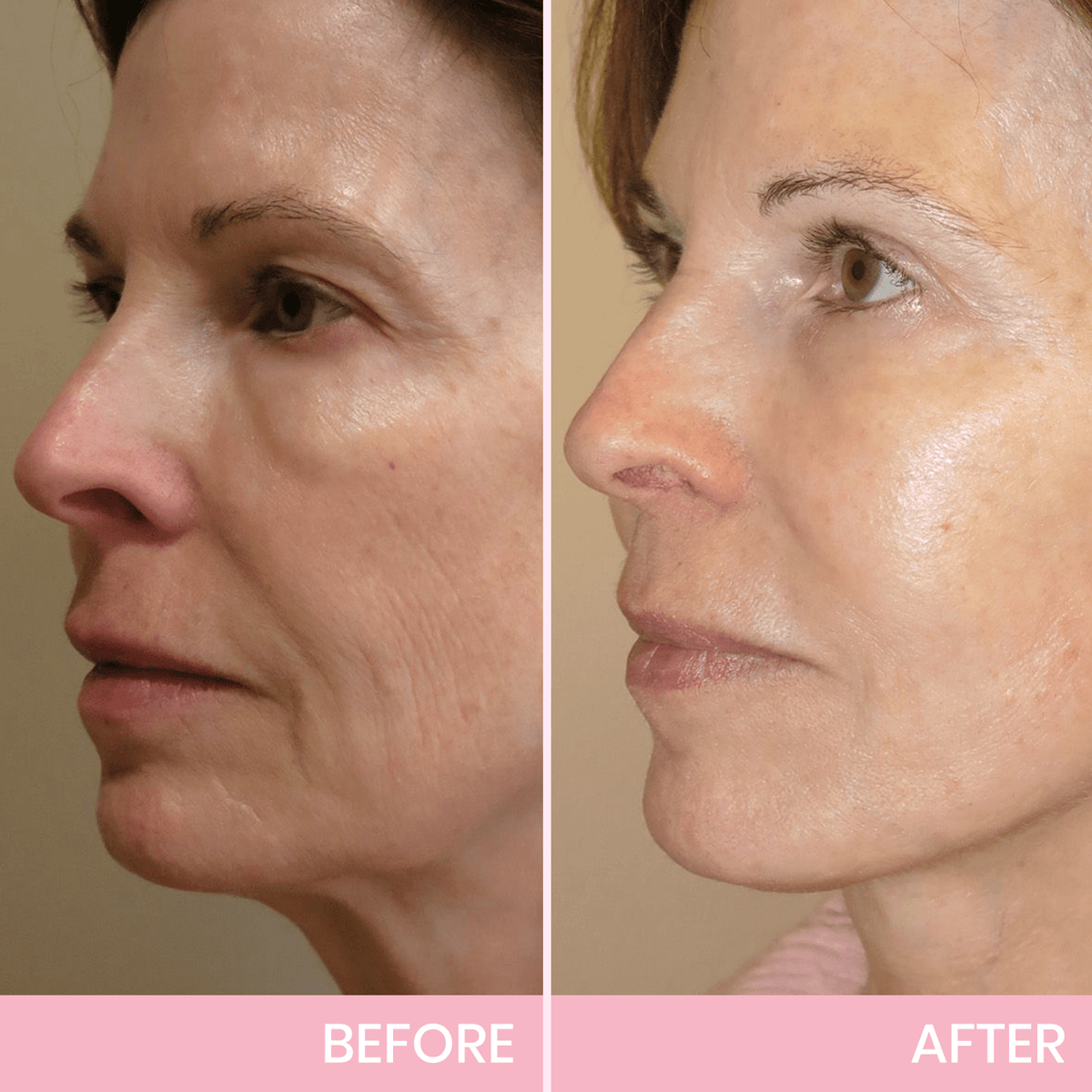 💖  Buy 1 Get 1 Free V-Face 👑 Invisible Lifting Tape
