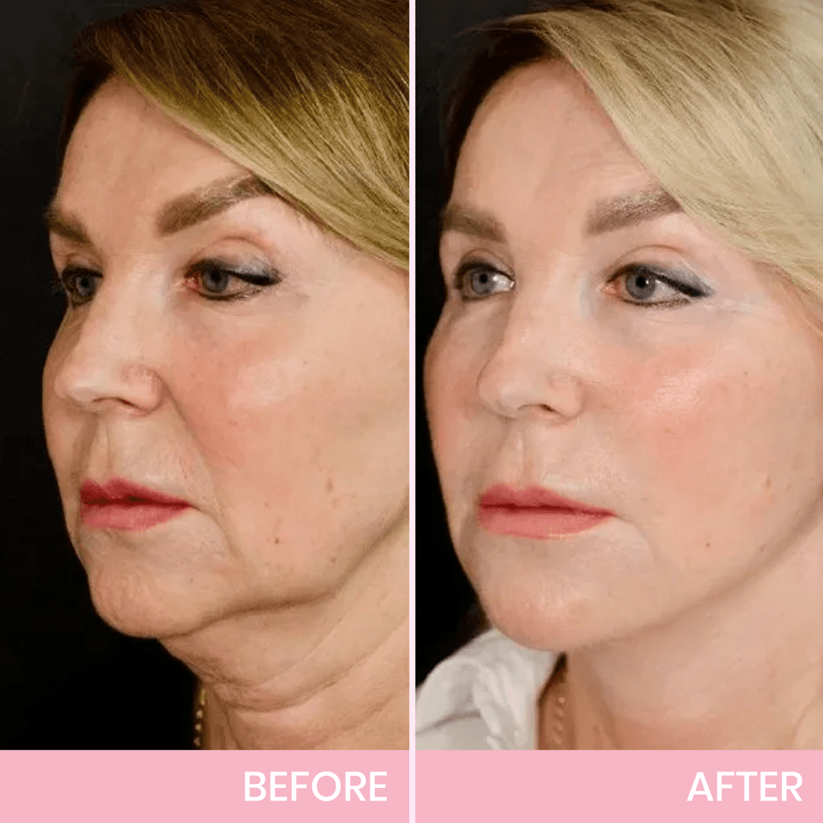 💖  Buy 1 Get 1 Free V-Face 👑 Invisible Lifting Tape