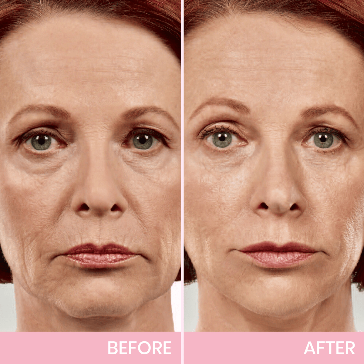 💖  Buy 1 Get 1 Free V-Face 👑 Invisible Lifting Tape
