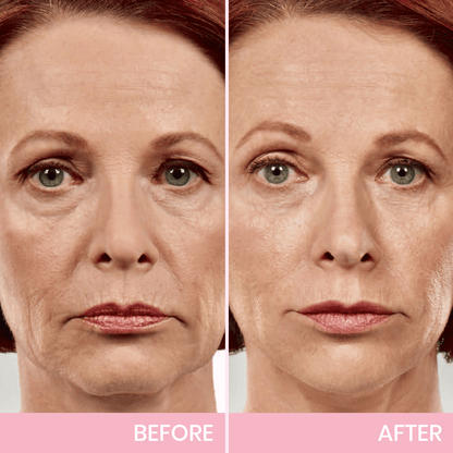 💖  Buy 1 Get 1 Free V-Face 👑 Invisible Lifting Tape