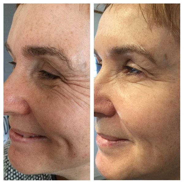 One® Instant Eye Tightener